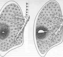 Pluća absces: simptomi, liječenje, dijagnoza, komplikacije, uzroci, simptomi