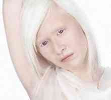 Albinizam kod ljudi, oka