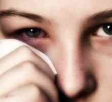 Alergijski konjunktivitis: liječenje, simptomi, uzroci, simptomi