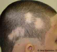 Alopecia areata: liječenje