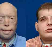 Američki kirurzi obavili transplantaciju spaljene face vatrogasac