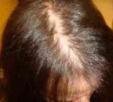 Androgena alopecija u žena, kod muškaraca: simptomi, liječenje