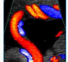 Anomalije srca, aorte i plućne debla fetusa. Doppler srca fetusa anomalije