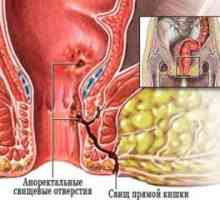 Anorcktalna apsces: liječenje, simptomi, uzroci