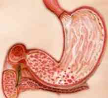 Antruma liječenje gastritisa i dijeta