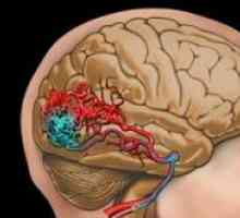 Arteriovenske malformacije leđne moždine