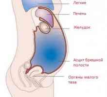 Ascites-peritonitis