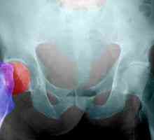 Aseptički nekrozu kosti: faza liječenja, uzroci, simptomi, znakovi