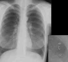 Ascaris u pluća, grla, nosa, dišnog sustava kod ljudi