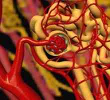 Ateroemboliya renalnih arterija
