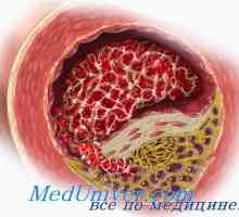 Ateroskleroza je u menopauzi i menopauzi. Učinak testosterona na arteriosklerozu androgena