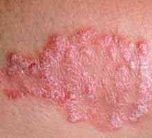Atopični dermatitis i seborični giardijaza