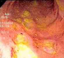 Atrofični crijevni kolitis