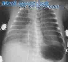 Barotrauma pluća tijekom dekompresije. Patogeneza plućne barotraumom