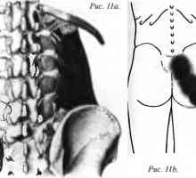 Bol u leđima uzrokovana Kvadratom lumborum