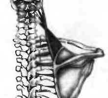 Bol u leđima uzrokovane mišića levator lopatica