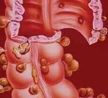 Crijevna divertikularne bolesti akutne i kronične upale divertikula