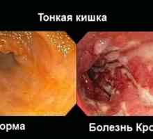 Crohnova bolest i ulcerozni kolitis