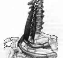 Bol u leđima uzrokovane nakrivni mišići