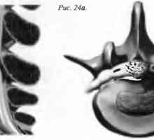 Bol u leđima hernija pulpozna jezgra (disk hernija)