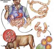 Goveđi (naoružani) parazit goveđi parazit infekcija u ljudi
