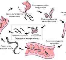 Česti infekcija (crv infestacije) pinworms (Enterobiasis) čovjek