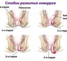 Četiri faza (opseg) hemoroida