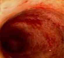 Što je crijeva enterokolitis?