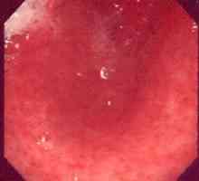 Što je katara gastroduodenitis?