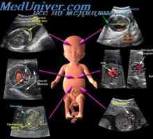 Color Doppler sonografija s molarna trudnoća. Boja mapping fetusa plovila
