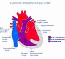 Klijetke septuma defekt srca: Uzroci, liječenje, simptomi, znakovi