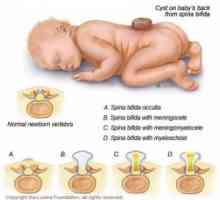 Oštećenje neuralne cijevi u djece: encephalocele, meningomyelocoele
