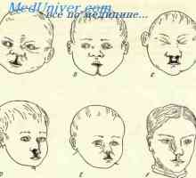 Nedostaci u razvoju lica embrija. Nedostaci u fetusu čeljusti