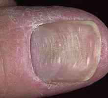 Deformacija noktiju: uzroci, liječenje