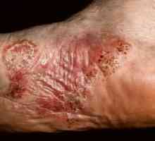 Dermatitis ruku i nogu