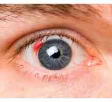 Dijabetička retinopatija: simptomi, liječenje, stadij, komplikacije