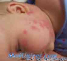 Dijagnoza alergije i druge nuspojave od lijekova u djece