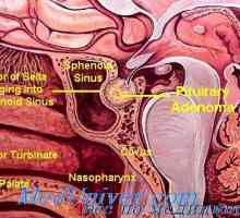 Dijagnoza, diferencijacija, liječenje i prognoza chromophobe adenoma hipofize