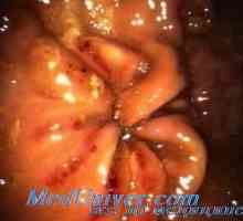 Disfunkcije hipofize-nadbubrežna sustava peptičkog ulkusa