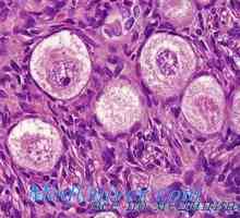 Disgerminoma seminom ili jajnika. tumori jajnika Lipoidnokletochnye virilizacijski