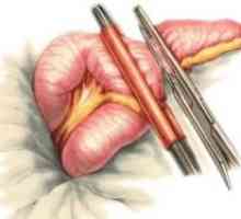Diverticulosis crijeva (kolona) liječenje, simptoma, dijagnoza