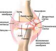 Dizenteričan (posledizenteriyny) artritis