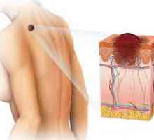 Benigni tumori kože: vrste, klasifikacija, liječenje, simptomi