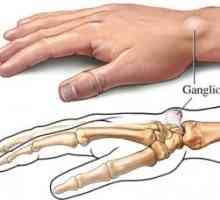 Benigni tumori mekih tkiva u ruke: liječenje, uzroci, simptomi, znakovi