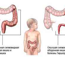 Dolichosigma crijeva u djece