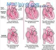 Srčani izlaz nakon srčanog udara. Kompenzirana zatajenje srca