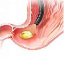 EGD u dijagnozi erozivni gastritis