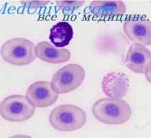 Utjecaj anemije na cirkulaciju krvi. policitemija erythremia