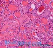 Folikularni velikih stanica adenokarcinoma i alveolarnog štitnjače