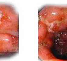 Oblici i faze Crohnove bolesti